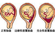 前置胎盤(pán)分哪幾種？有什么癥狀？